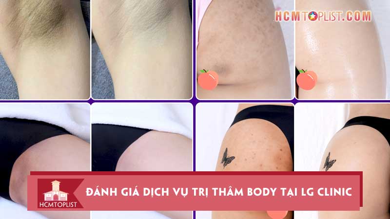Danh-gia-dich-vu-tri-tham-body-tai-lg-clinic-hieu-qua-muc-gia-va-trai-nghiem-thuc-te