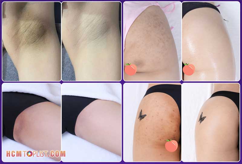 Ket-qua-dieu-tri-tham-body-nhieu-vung-tai-lg-clinic